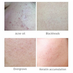 AICHUN BEAUTY Salicylic Acid Purifying Shrink Pores Exfoliation Anti-Acne Face Serum - 30ml