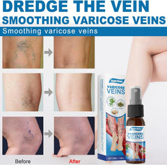 South Moon Vein Healing Varicose Veins Treatment Spray - 30ml