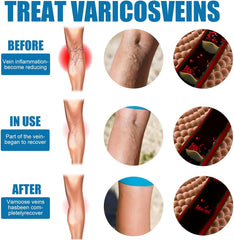 South Moon Vein Healing Varicose Veins Treatment Spray - 30ml