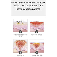 Dr Rashel Aloe Vera Anti Acne Pimple Cream - 30gm