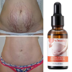 KORMESIC Skincare for Natural Belly Care Remover Stretch Mark Oil - 100ml