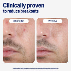 Cetaphil Gentle Clear Acne Cleanser - 124ml