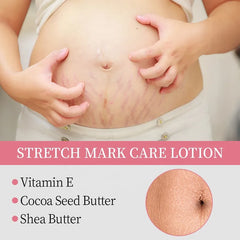 KORMESIC Stretch Mark Care Lotion – 200ml