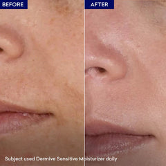 Dermive Sensitive Moisturizer Soothes Skin | Relieves Itching - 100ml