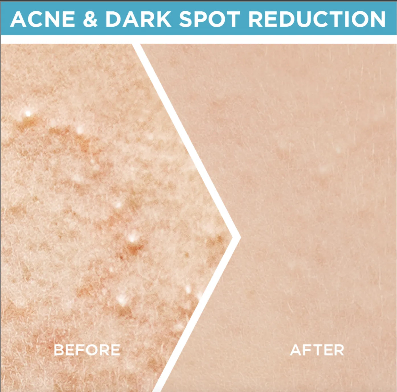 Garnier Skin Active Fast Clear Booster Serum For Acne Prone Skin