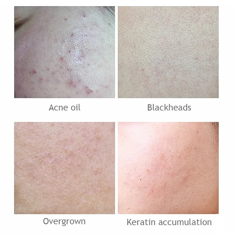 AICHUN BEAUTY  Salicylic Acid Purifying Shrink Pores Exfoliation Anti-Acne Face Serum - 30ml