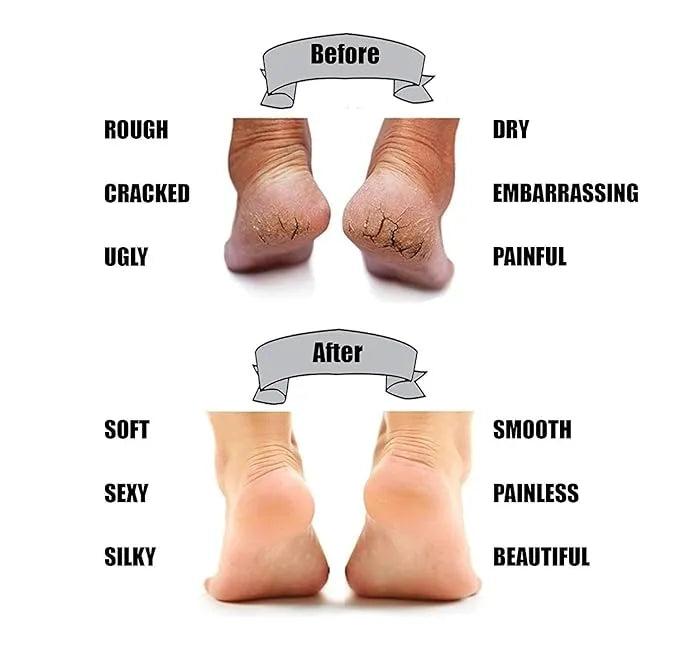 Anti Crack Silicone Gel Heel & Foot Protector