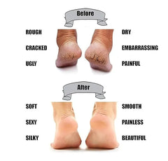 Anti Crack Silicone Gel Heel & Foot Protector