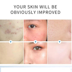 AICHUN BEAUTY  Salicylic Acid Purifying Shrink Pores Exfoliation Anti-Acne Face Serum - 30ml