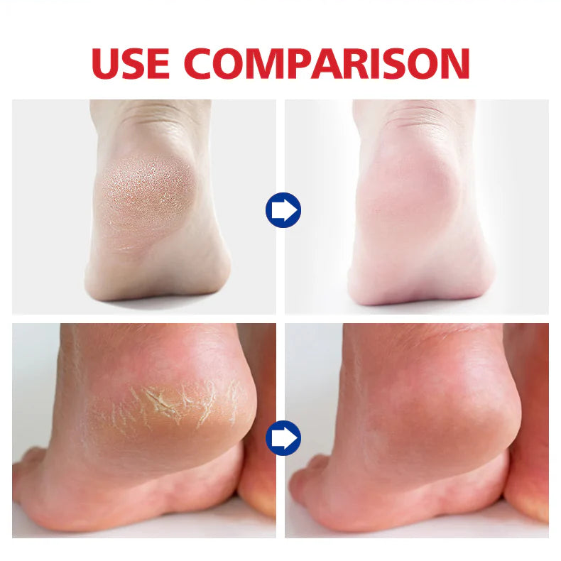 Aichun Beauty Foot Cream Balm For Cracked Heel Dead Skin Remover Foot Cream - 20g