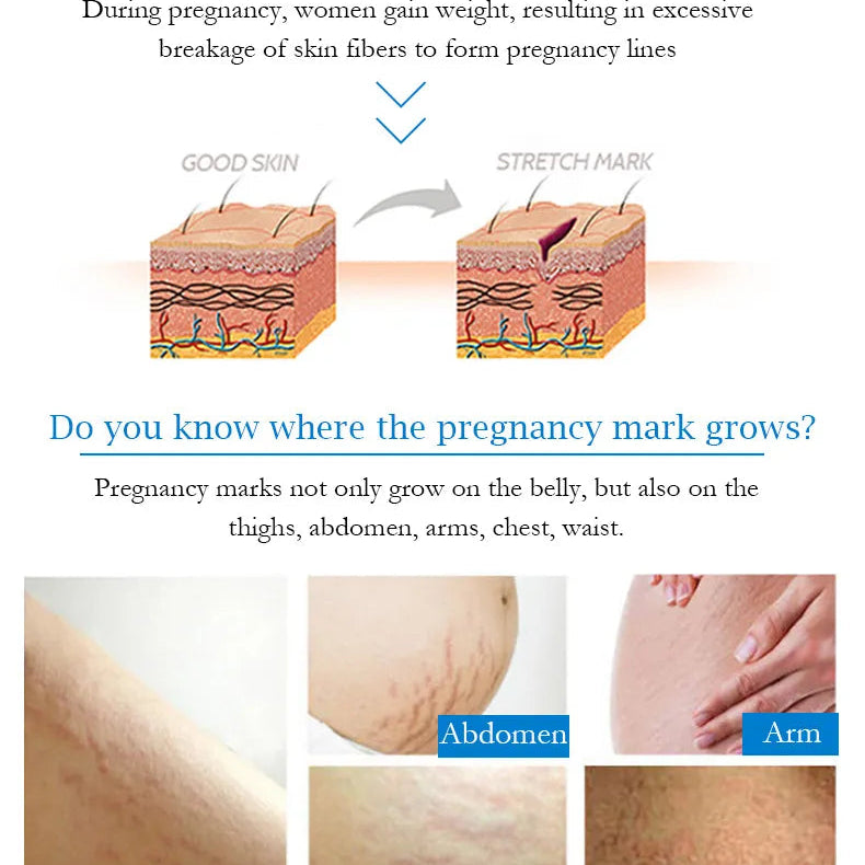 Guanjing Remove Stretch Marks Cream Anti-Wrinkle Maternity Skin Repair - 80g