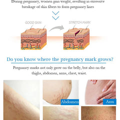 Guanjing Remove Stretch Marks Cream Anti-Wrinkle Maternity Skin Repair - 80g