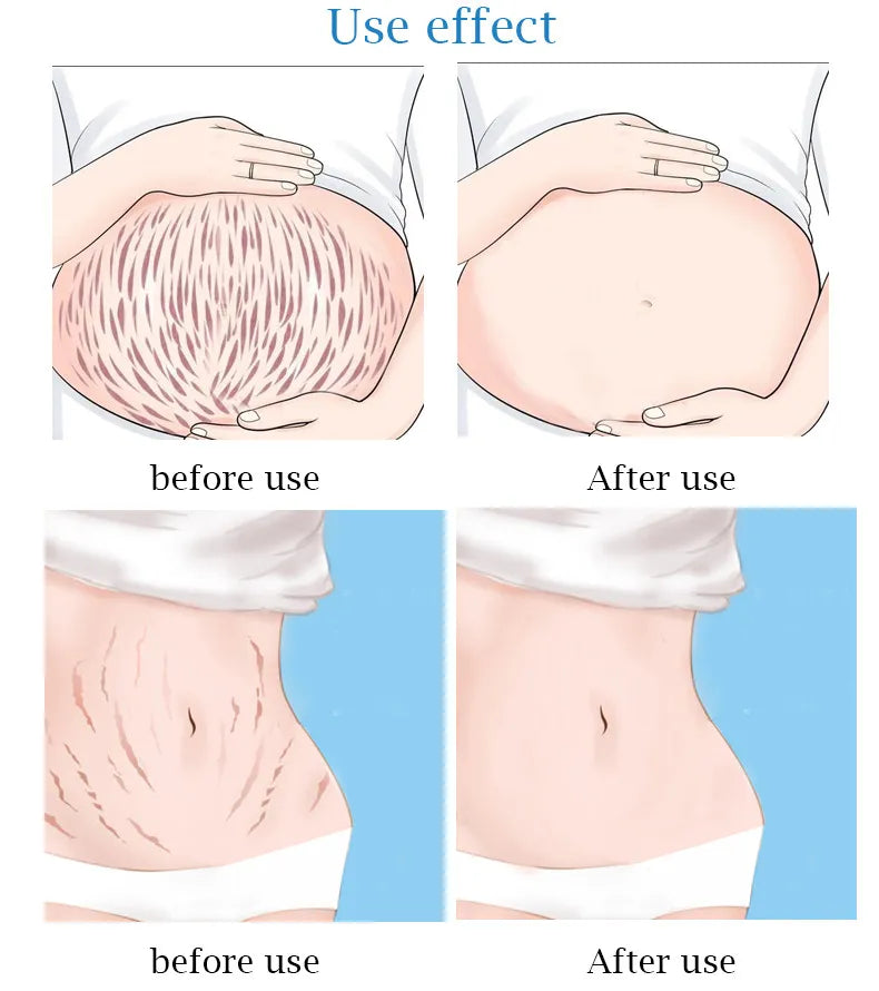 Guanjing Remove Stretch Marks Cream Anti-Wrinkle Maternity Skin Repair - 80g