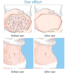 Guanjing Remove Stretch Marks Cream Anti-Wrinkle Maternity Skin Repair - 80g