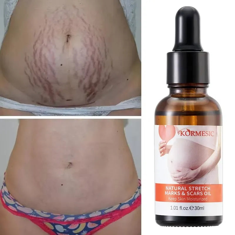 KORMESIC Skincare for Natural Belly Care Remover Stretch Mark Oil - 100ml