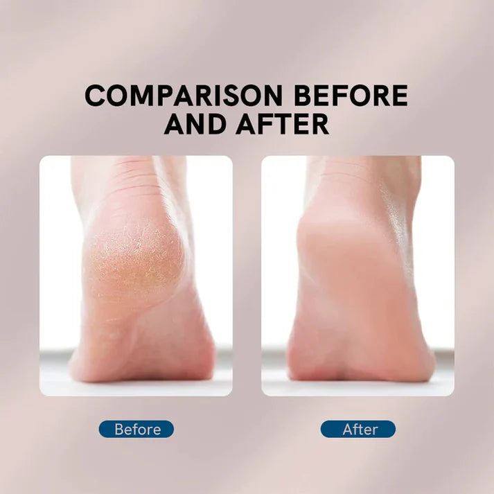 Flawless Electric Foot Callus Remover