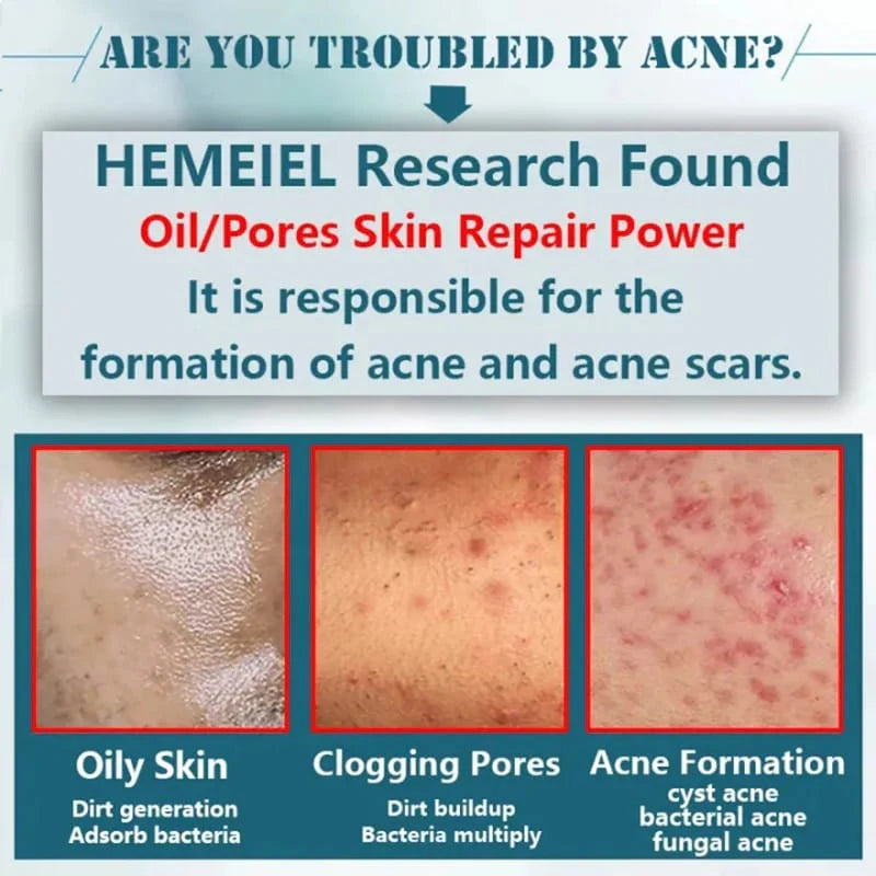 Sadoer Tea Tree Acnes Oil Control Face Cream - 50g