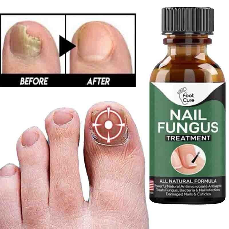 Fast Nail Fungal Treatments Nail Repair Essences Serum