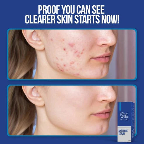 Wiki Special Anti Acne Serum - 30ml