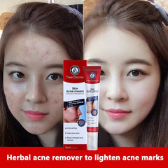 Tree Doctor Skin Acne Cream - 30g